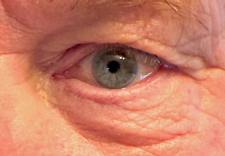 image of Jeff Sundin after having left eye lens replacement using PanOptix